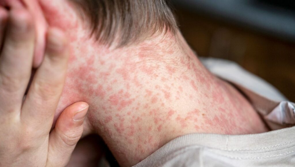 PAHO-calls-for-regional-action-as-the-Americas-lose-measles-elimination-status